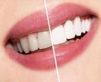 Отбеливание зубов: виды профессионального отбеливания и домашние методы