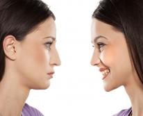 Ринопластика: все, что нужно знать о коррекции формы носа
